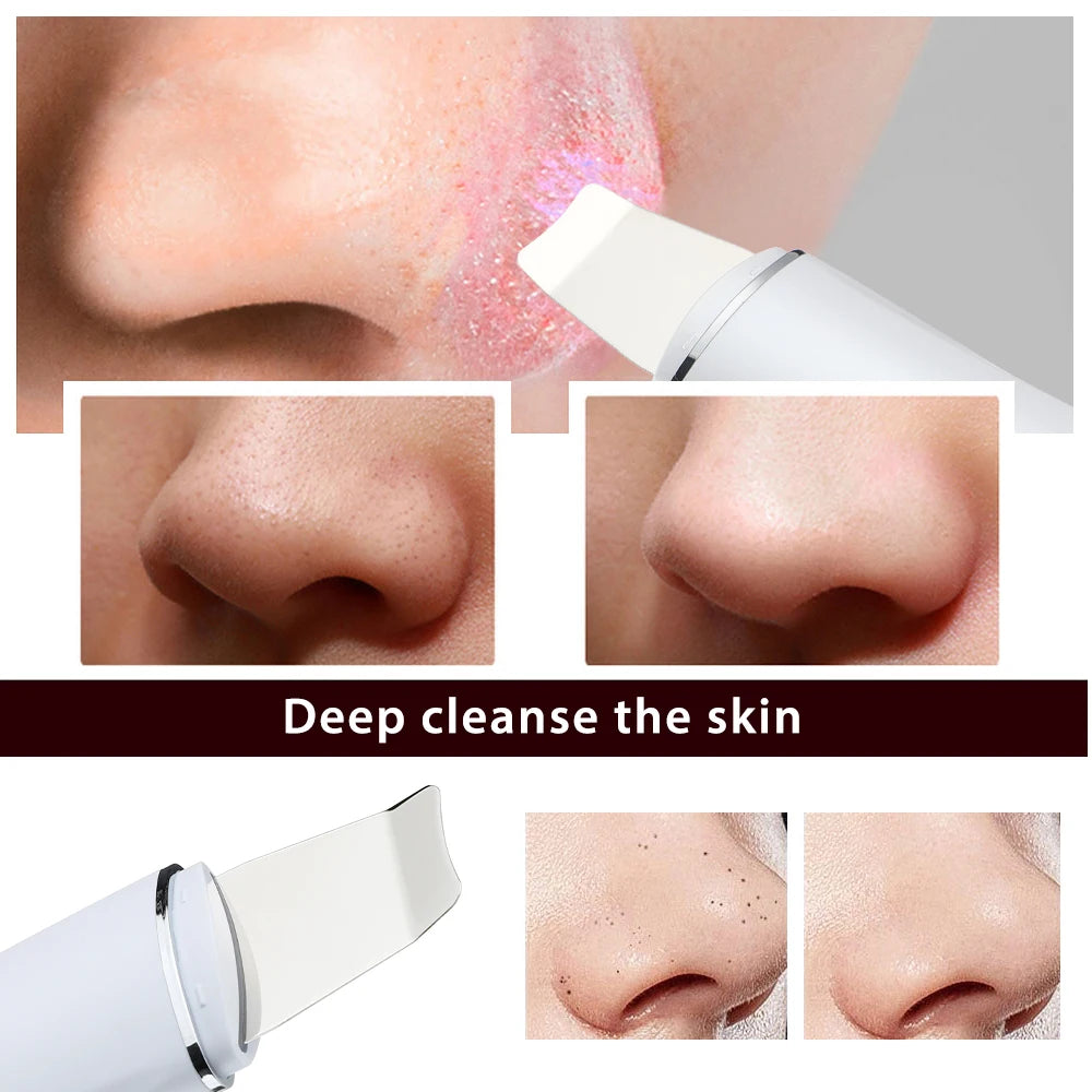 Ultrasonic Skin Scrubber Peeling Shovel Acne Blackhead Remover High-frequency Vibration Pore Deep Cleansing Facial Lifting Tools